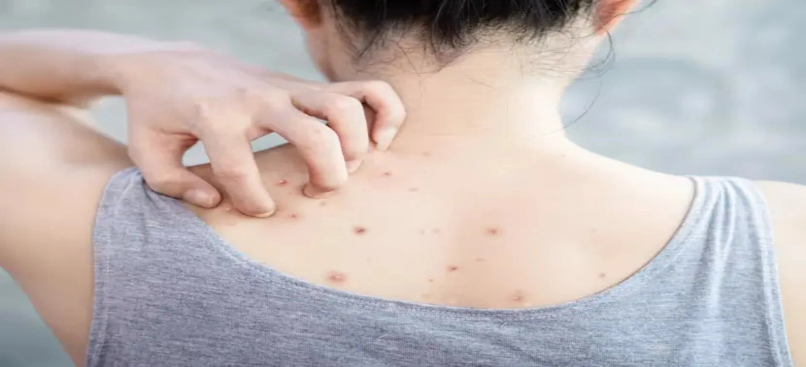 Body acne