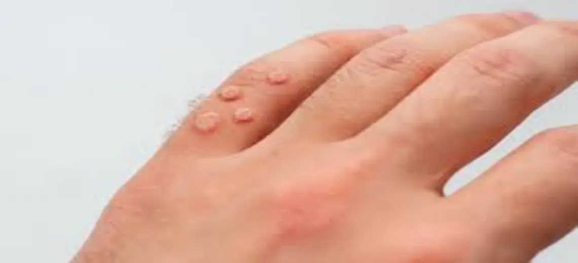 Everything You Need to Know About Warts